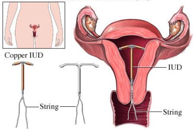 The Suggested Advantage of IUDs: Have the Risks Changed or Just Our Perception?